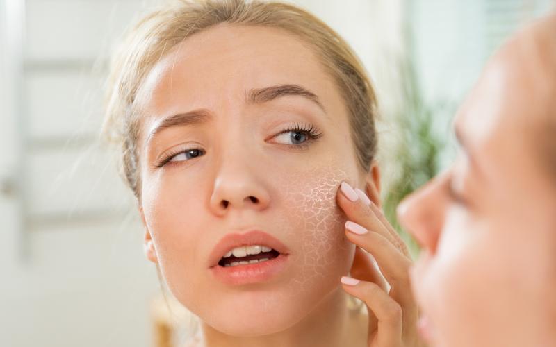 main of There Are Many Ways to Avoid or Treat Dry Skin