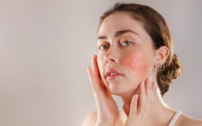 thumbnail of Reddened Skin Is The Trademark Sign of Rosacea