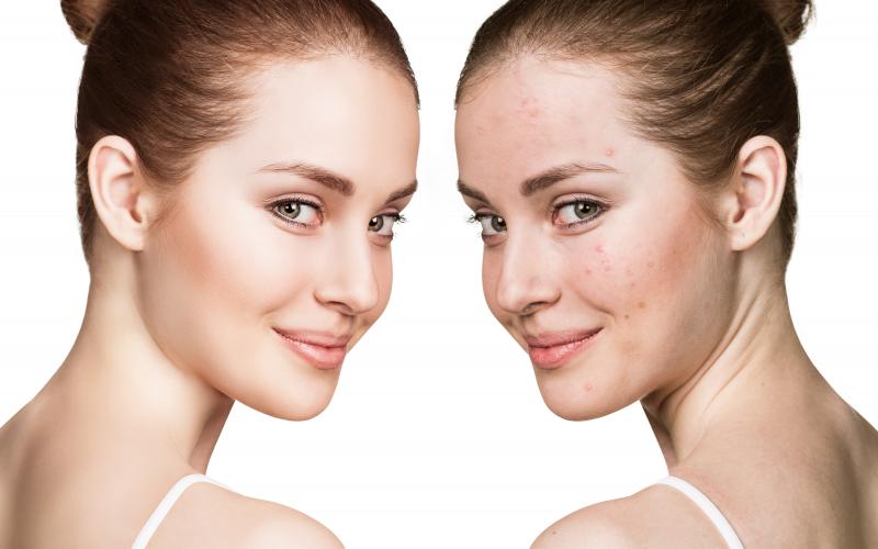 main of There Are Many Ways People Choose To Treat Acne