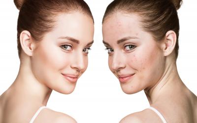 thumbnail of There Are Many Ways People Choose To Treat Acne