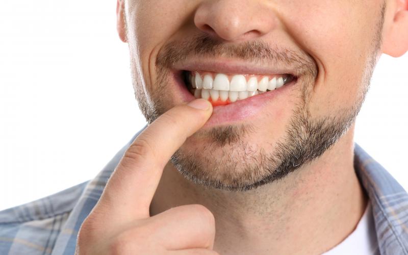 main of Gum Disease Can Be Prevented or Minimized With The Right Dental Routine