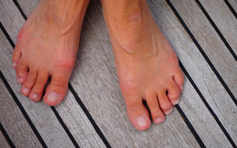 main of Some People Find Hammer Toe to Be Unsightly