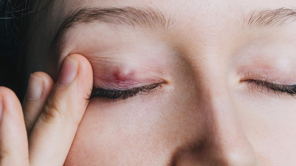 An Eye Stye is Unsightly and Often Painful